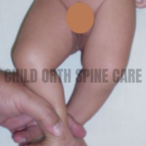 hip dislocation
